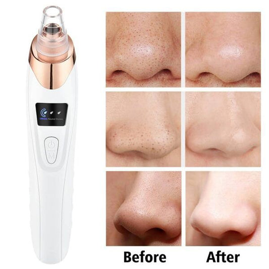 Electric Blackhead Remover | Deep Cleansing for Radiant Skin